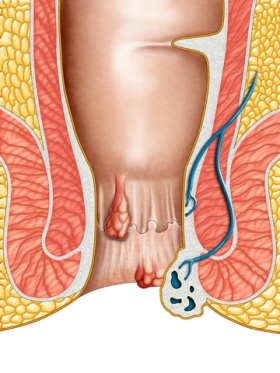 Natural home remedies for hemorrhoids that work like a bomb!