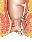 Natural home remedies for hemorrhoids that work like a bomb!