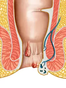 Natural home remedies for hemorrhoids that work like a bomb!