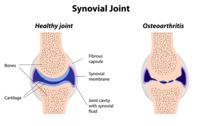 healthy versus arthritic joint