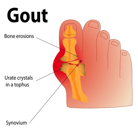 gout-in-the-big-toe