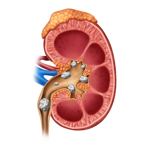 Prone to Stones?  Review some good eating habits in these Natural Kidney Stone Remedies.