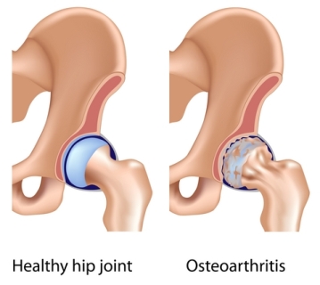 Natural Remedies Arthritis Hip Joint Natural Remedies Arthritis Hip Joint