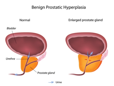 Easy and simple home remedies for enlarged prostate