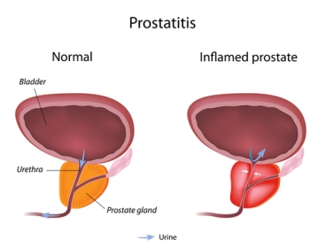 Pressing the panic button because of frequent urination - stop, and read up our home remedies for prostatitis first.