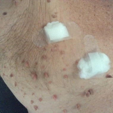 skin tags