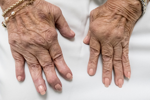 A list of herbs for rheumatoid arthritis which help boost  the immune system, are natural anti-inflammatories and natural antioxidants.