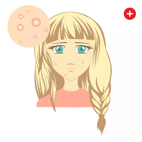 Acne Home Remedies..... see how you can help prevent or heal the scourge of pimples naturally and at the same time using remedies that are easy on the pocket.