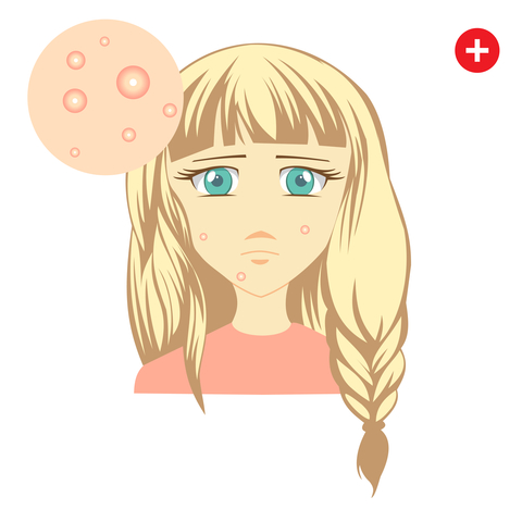 Acne Home Remedies..... see how you can help prevent or heal the scourge of pimples naturally and at the same time using remedies that are easy on the pocket.