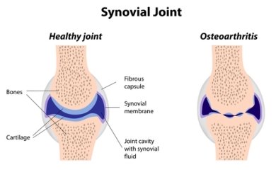 healthy versus arthritic joint