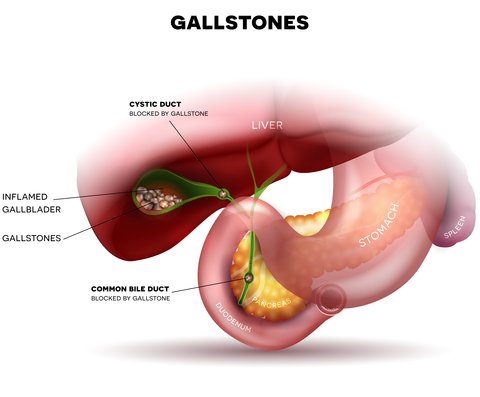 The pain from having gallstones is excruiting, it makes you just want to curl up in a ball and cry. Take a look at some of our home remedies for gallstones.