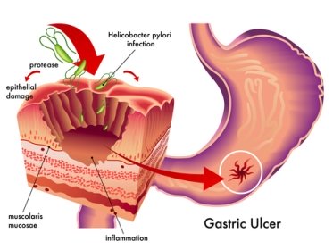 This is where you will find genuine home remedies for ulcers, and you will find out the real causes of stomach ulcers and see remedies for immediate relief 