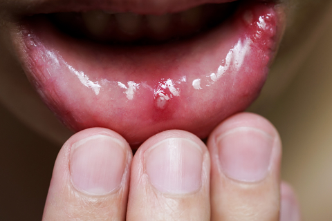 mouth ulcers