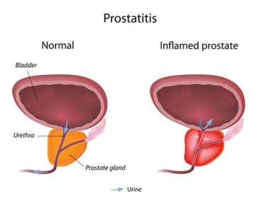 Pressing the panic button because of frequent urination - stop, and read up our home remedies for prostatitis first.