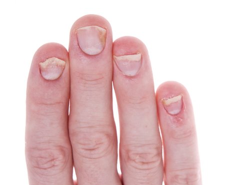 psoriasis on fingernails