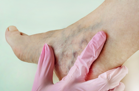 Natural Remedies for Varicose Veins - Help for the lumpy, kinked blue veins in your beautiful legs.